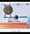 曲安奈德导致皮肤白斑