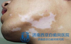 济南哪里可以治疗白癜风 济南哪里可以治疗白癜风