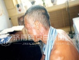 张大爷 63岁 全身散发型白斑7年 聊城人