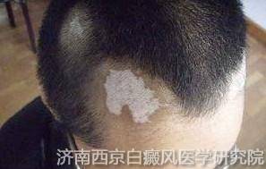 济南白癜风有哪些医院