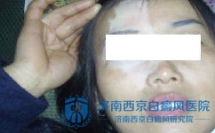 脸上长白癜风的危害