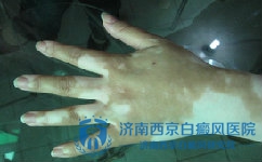手上的白癜风能吗 手上的白癜风能吗