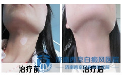 颈部白癜风患者该如何调整自己的情绪 颈部白癜风患者该如何调整自己的情绪