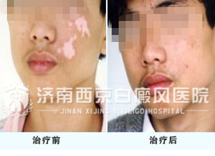 青少年白癜风怎么治
