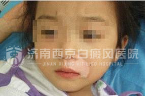 特殊部位长了白癜风该怎么办 特殊部位长了白癜风该怎么办