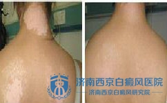 白癜风应该如何预防的好 白癜风应该如何预防的好