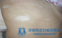 白癜风发病初期什么症状