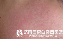 白癜风是不是冲突后都会变红