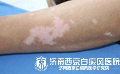 为何皮肤破口处患白癜风
