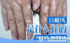 白癜风症状表现有哪些