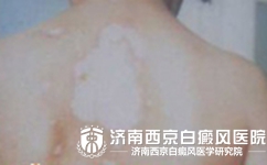 皮肤变白是不是得了白癜风