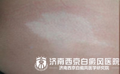 在伍德灯下发白的即是白癜风吗
