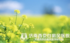 白癜风会随着年纪而扩散吗