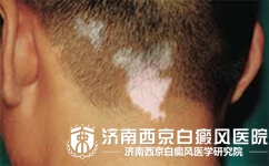 如何来预防颈部白癜风发病