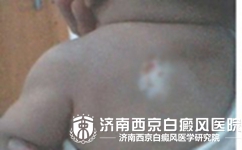 小儿白癜风该怎么确诊