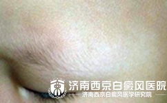 白癜风对眼睛有哪些影响