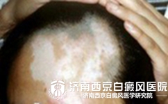 头部白癜风会出现哪些危害